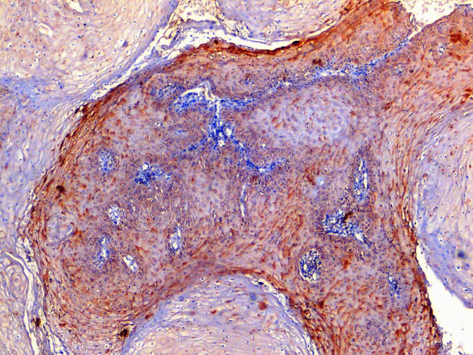 Photomicrograph of well differentiated OSCC showing strong intensity of staining (EP3 IHC, 20x)