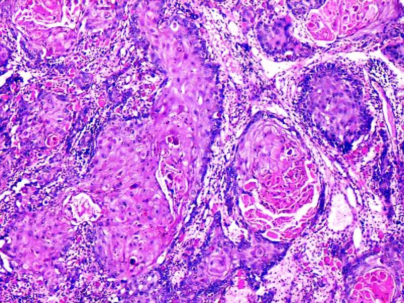 Well differentiated SCC with abundant keratinization, prominent intercellular bridges, nucleoli, atypical mitosis, marked pleomorphism and mild degree of lymphocytic infiltrate (H&E, 20x).