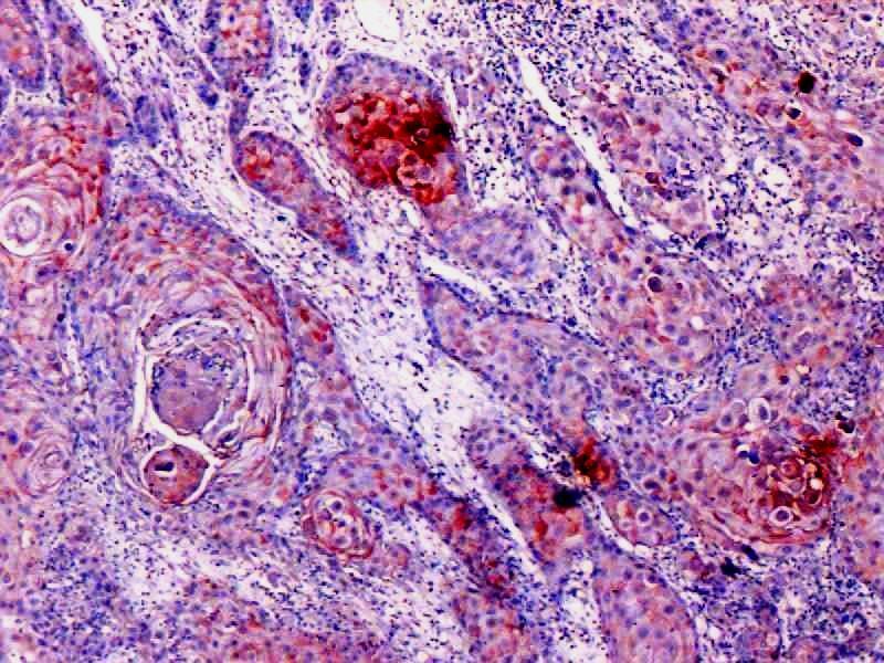 Photomicrograph of well differentiated OSCC showing moderate to strong intensity of staining (EP3 IHC, 20x).