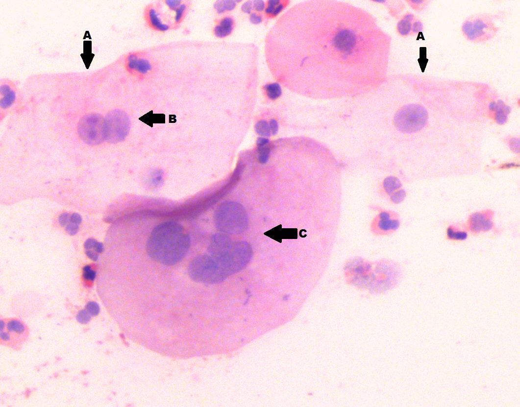 Photomicrograph showing features of nuclear atypia, prominent nucleoli( A arrow),  binucleation (B arrow) and nuclear budding (C arrow) in normal oral buccal mucosa exfoliated epithelial cells ( H&E stain, 40X)