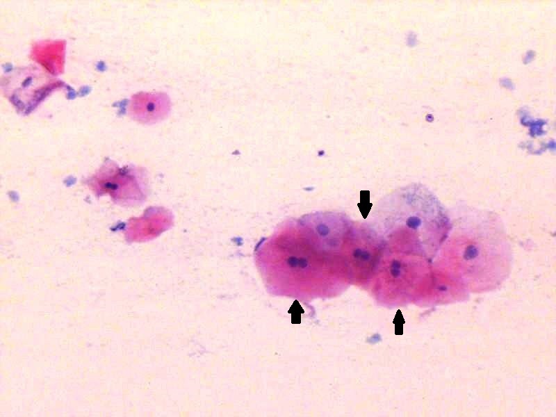 Photomicrograph showing binucleation (arrow) in normal buccal mucosa exfoliated epithelial cells (H&E stain, 20X)