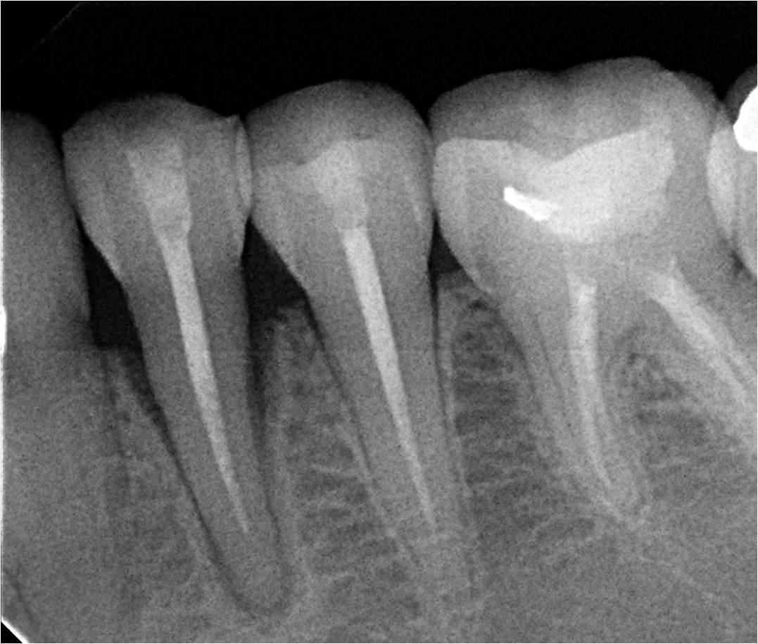 Pre op radiograph showing bone loss around the premolar