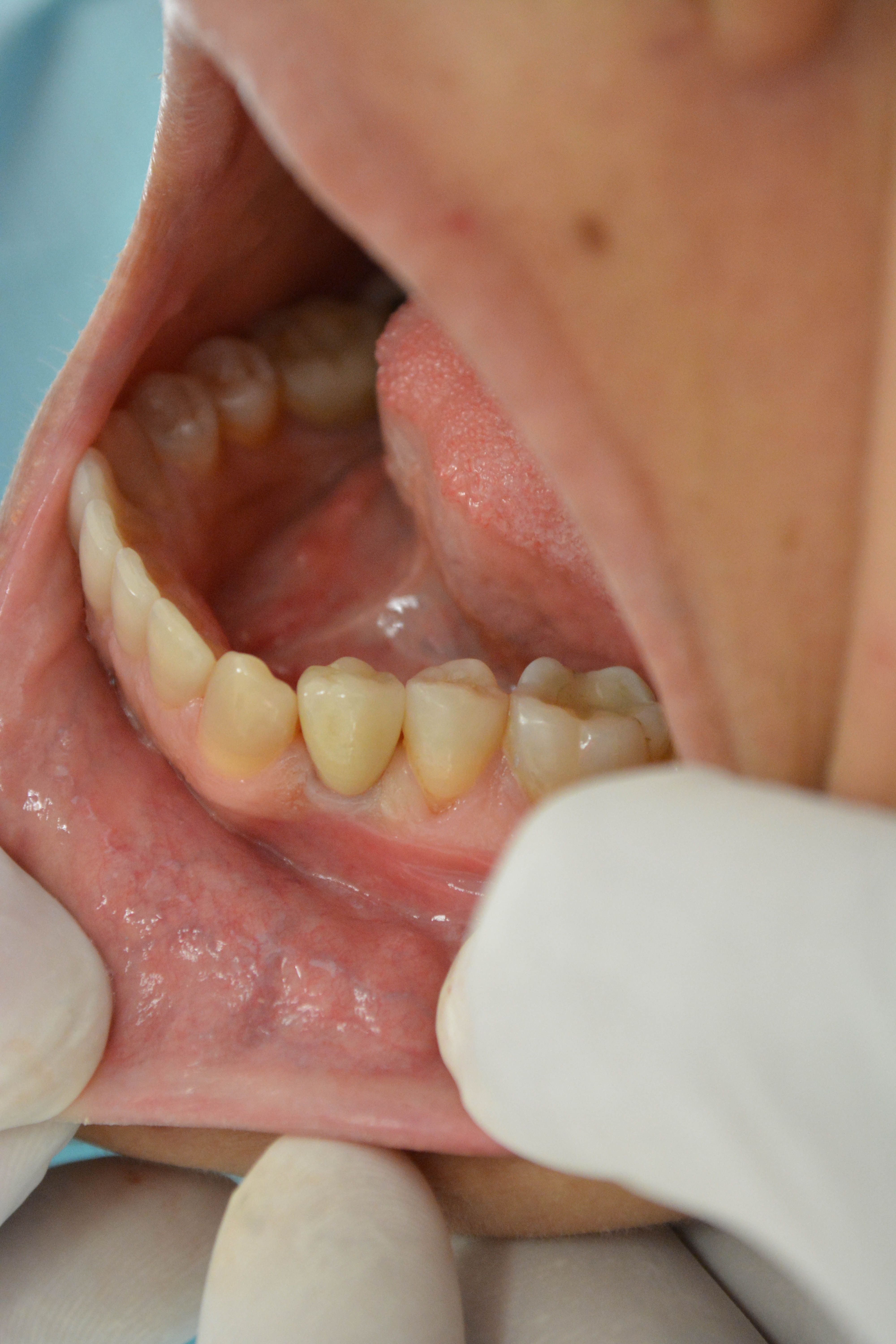 After the extraction an immediate implant was placed and restored with a crown.