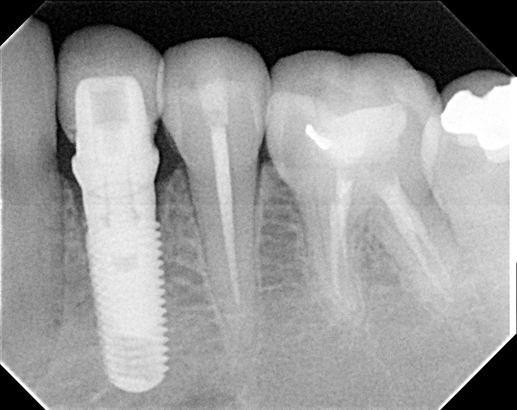 Radiograph: Implant in place.