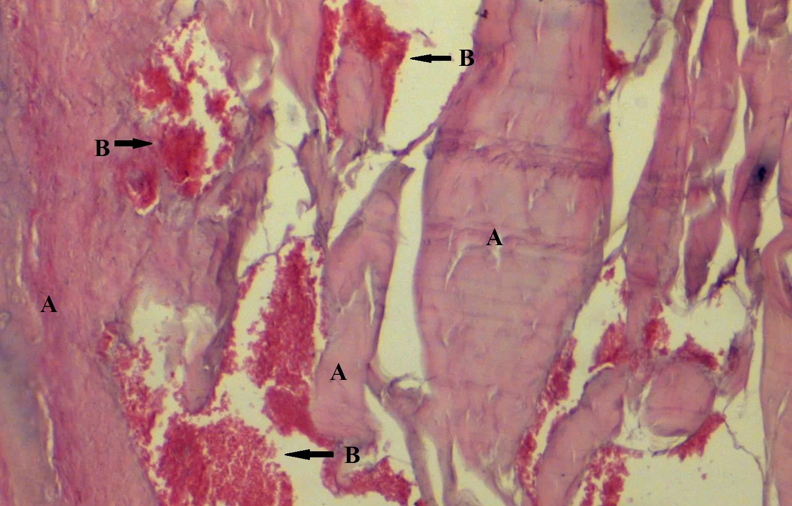 Photomicrograph from maxilla of an experimental animal in high dose group showing destructed bony trabeculae (A) with extensive haemorrhage in marrow spaces (B). (H&E, 200x)
