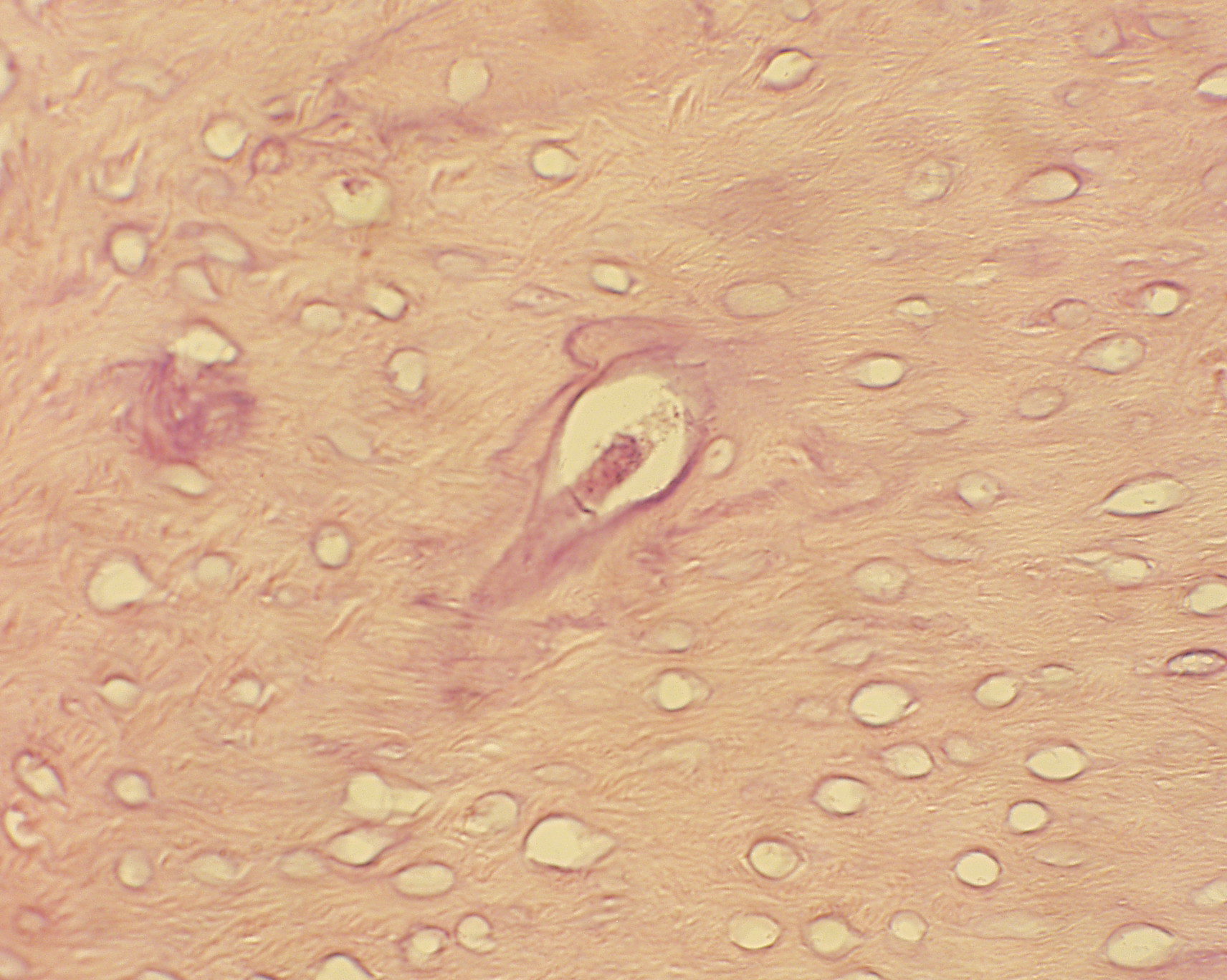 Necrotic bone from extraction site in rat treated with zolendroic acid but not treated with Sanuwave ECSWT.
