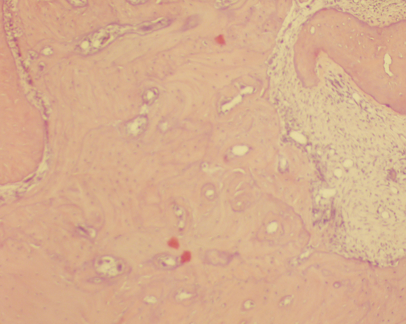 Osseous healing in extraction site of rat molar subsequent to indiuction of ONJ with zolendroic acid followed by Sanuwave ECSWT treatment.