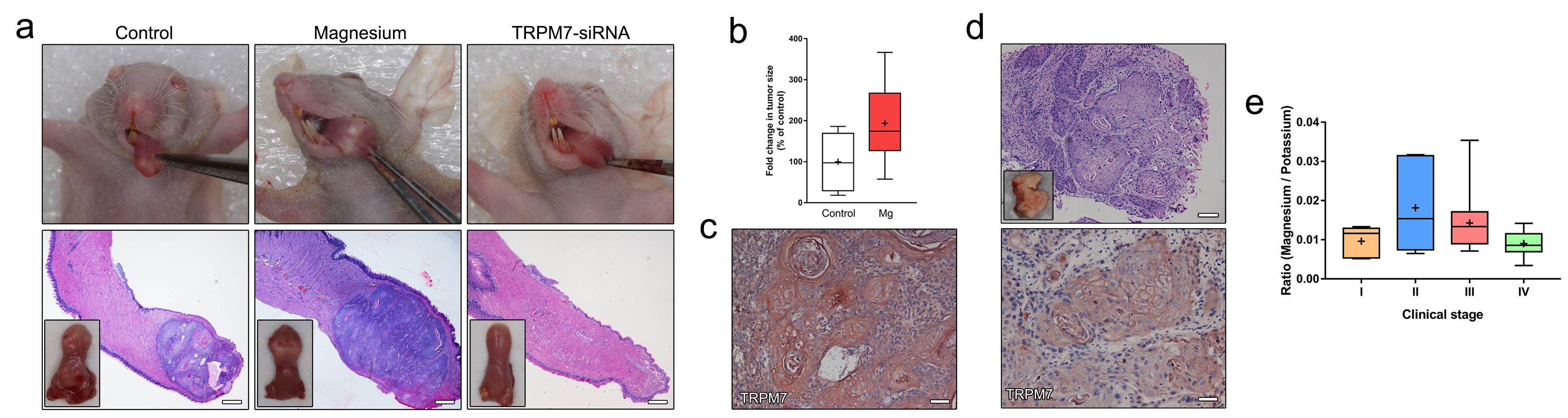 Figure 2. The growth of xenograft tumors in mouse tongues was accelerated by the addition of magnesium in drinking water, but inhibited by the silence of TRPM7 channel (a & b). The expression of TRPM7 was increased in xenograft tumors in mouse (c) and tumor tissues from head and neck cancer patients (d). Salivary magnesium level was elevated in stage II & III NPC patients (e).<br />
