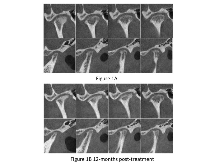 Figure 1 A, right condyle of a 16-year-old female, presenting loss of continuity of articular cortex at the initial visit; B, progressed category: right condyle presenting with articular surface erosion and flattening without ARS therapy at 12 months post-treatment.<br />