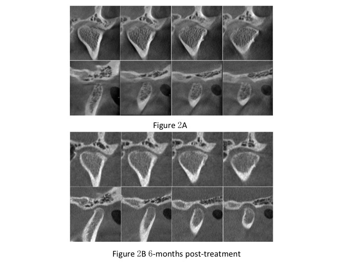 Figure 2 A, left condyle of a 23-year-old female, presenting with articular surface destruction; B, repaired (remodeled without new bone formation) category: left condyle presenting with smooth articular surface without ARS therapy at 6 months post-treatment.