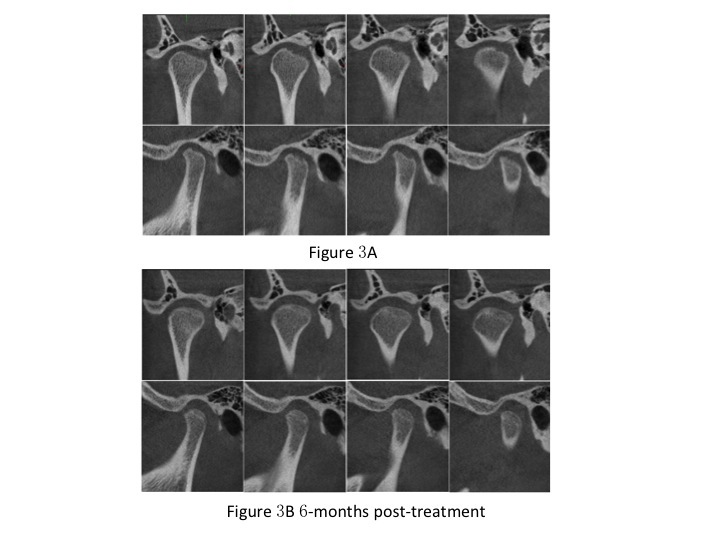 Figure 3 A, right condyle of a 15-year-old female, presenting with articular surface destruction; B, regenerated (remodeled with new bone formation) category: right condyle presenting with “double contour” images over the previous bony defect at 6 months post-ARS therapy.