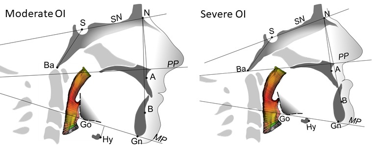 Schematic illustration of the range of craniofacial deformities in Osteogenesis Imperfecta