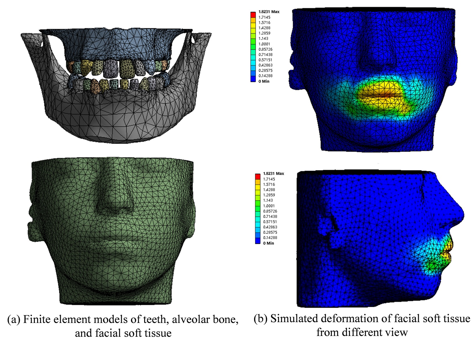 Finite element models and simulation results of the facial soft tissue deformation.