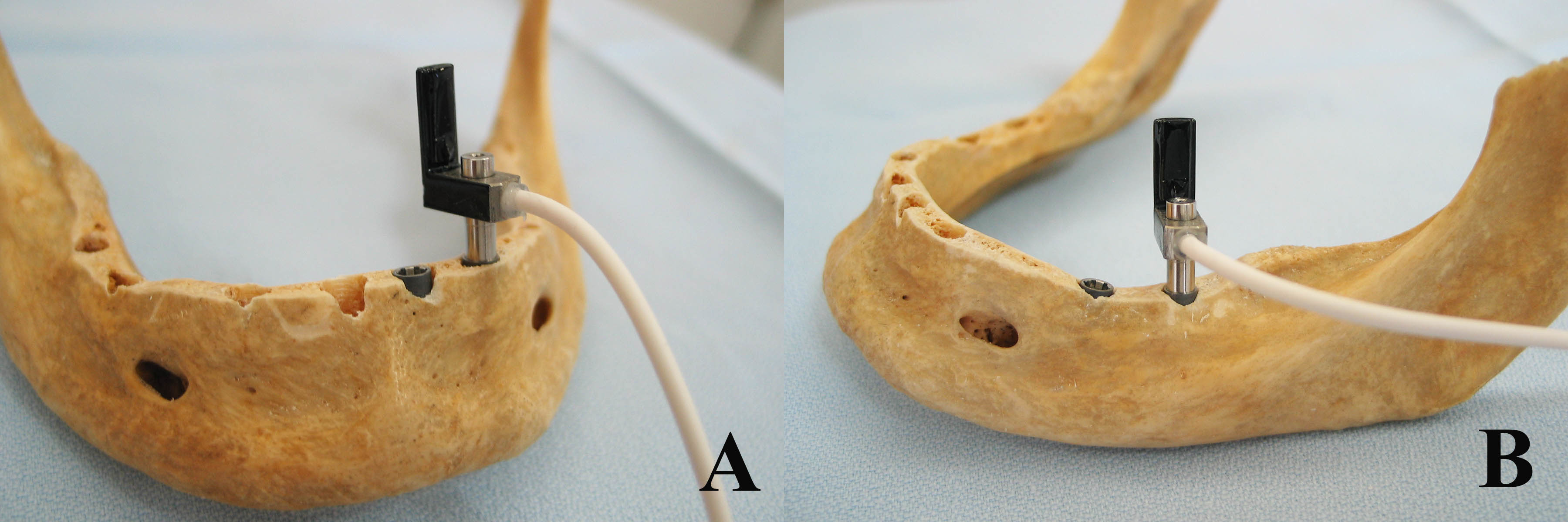 Modified Implant Site Preparation Method To Increase Primary Implant