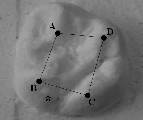 Identification of the cusps from the occlusal surface of a first upper permanent molar. A. Cusp 1, mesobuccal, paraconus; B. Cusp 2, mesolingual, protoconus; C. Cusp 3, distobuccal, metaconus; D. Cusp 4, distolingual, hypoconus; and * Carabelli-cusp.
