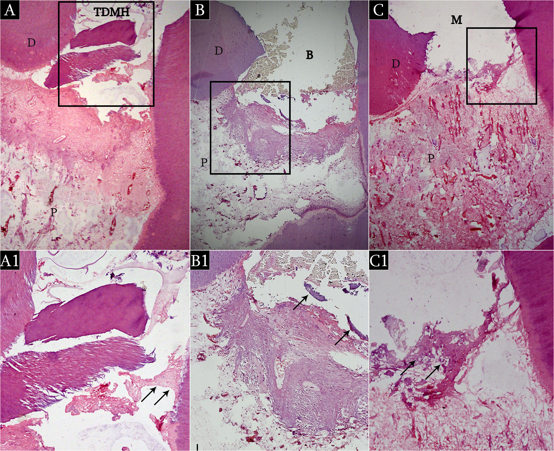 <i>Fig.1:</i> Light micrographs of human pulp capped with (A) TDMH, (B) Biodentine and (C) MTA at two weeks interval showing initial dentin bridge formation (arrows) and early pulp reaction to applied materials, x40. (A1, B1, C1) Higher magnification of boxed areas (A, B, C), x200. (hematoxylin-eosin; TDMH, Treated Dentin Matrix Hydrogel; B, Biodentine; M, MTA; D, primary dentin; P, pulp).<br />
<br />
<br />
<br />
<br />