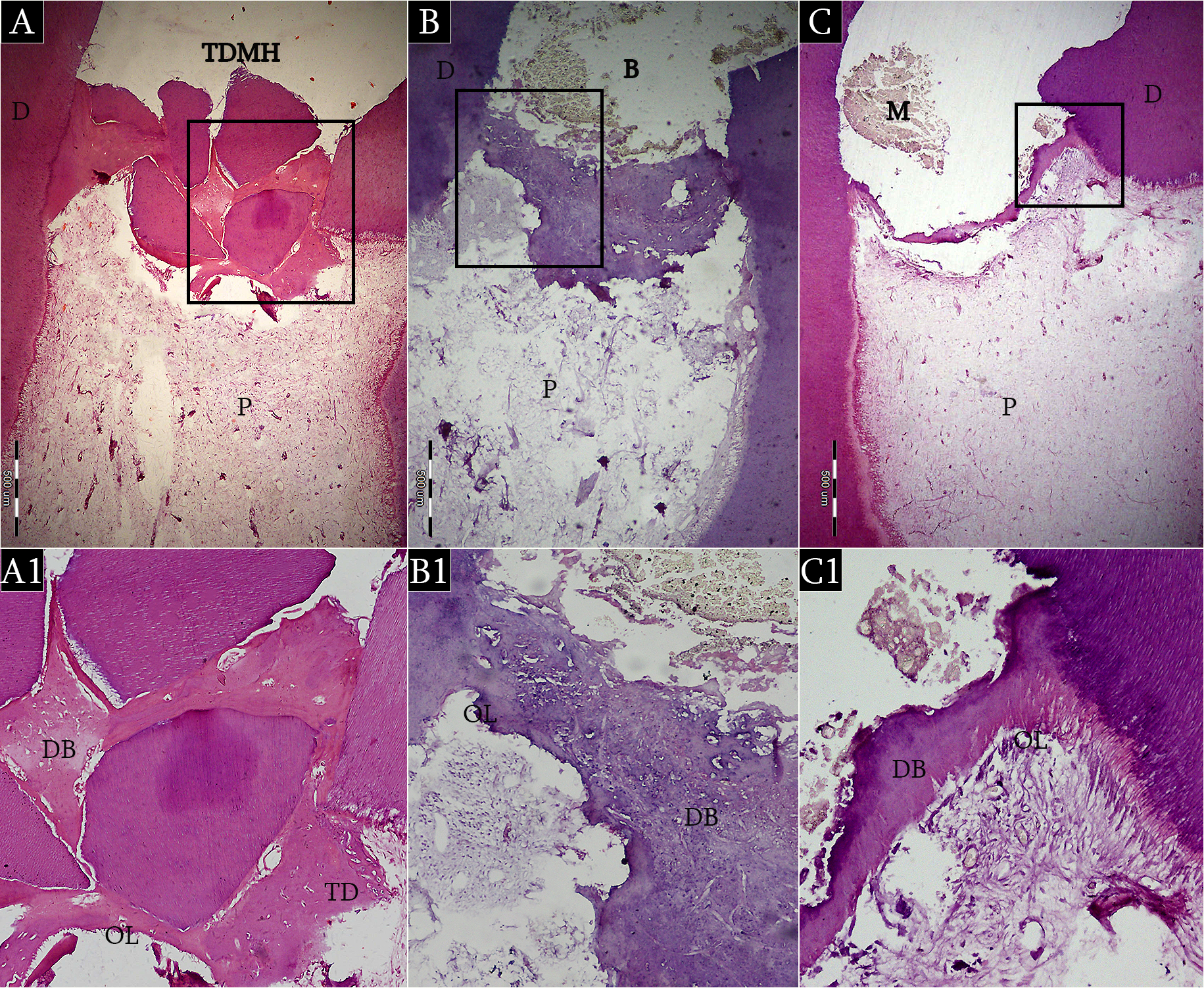 <i>Fig.2:</i> Light micrographs of human pulp capped with (A) TDMH, (B) Biodentine and (C) MTA at two months interval showing complete dentin bridge formation and absence of inflammatory pulp response, x40. (A1, B1, C1) Higher magnification of boxed areas (A, B, C), x200. (hematoxylin-eosin; TDMH, Treated Dentin Matrix Hydrogel; B, Biodentine; M, MTA; D, primary dentin; TD, tubular dentin; DB, dentin bridge; OL, odontoblast layer; P, pulp).