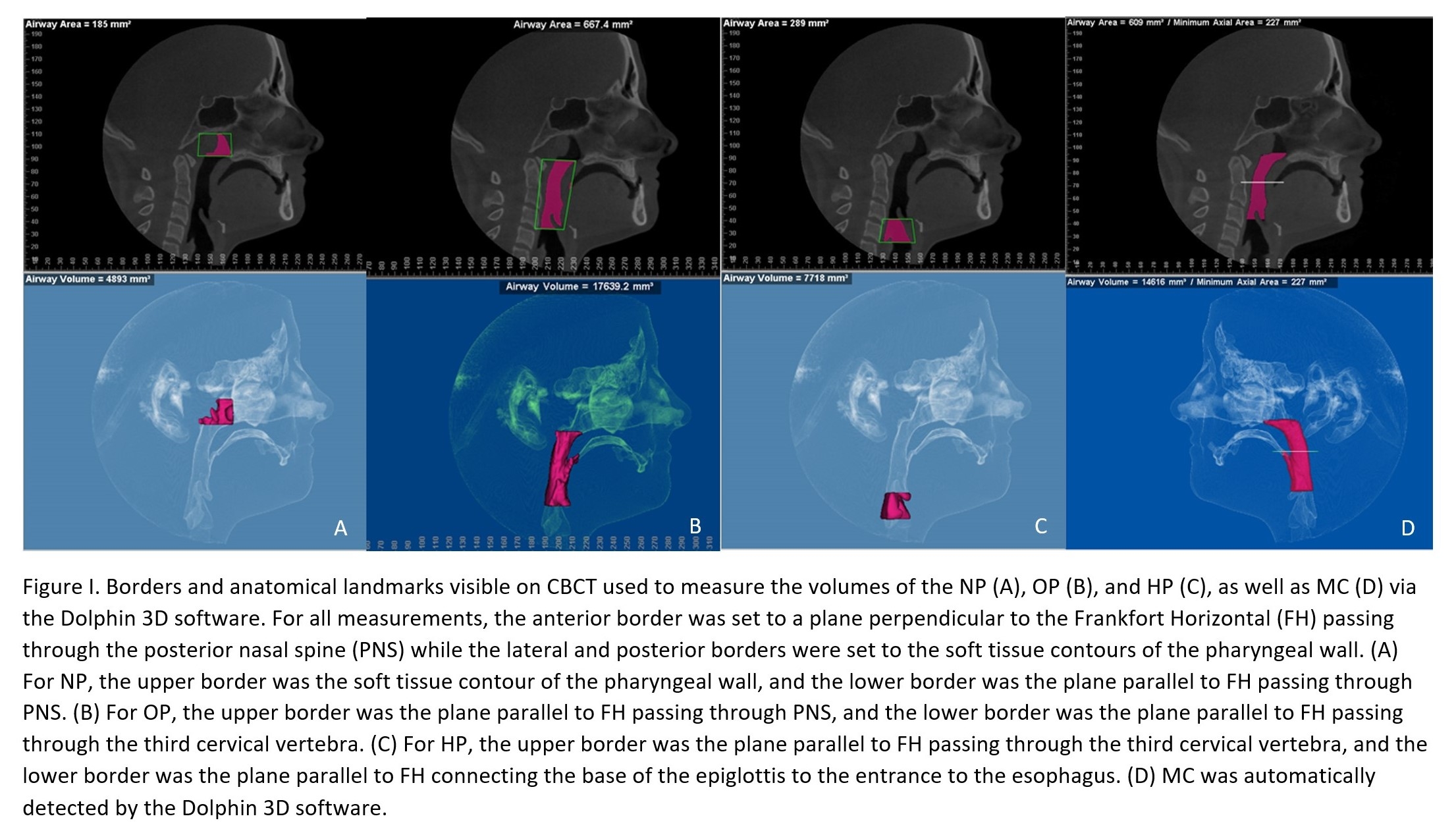Figure I. Borders and anatomical landmarks visible on CBCT used to measure the volumes of the NP (A), OP (B), and HP (C), as well as MC (D) via the Dolphin 3D software.