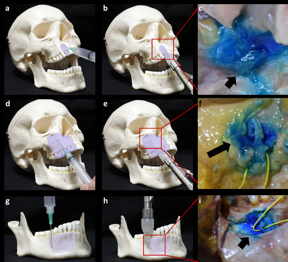 Figure 2 The anesthesia technique for needle and needle-free dental anesthesia on infiltration, infraorbital nerve block, and mental nerve block.