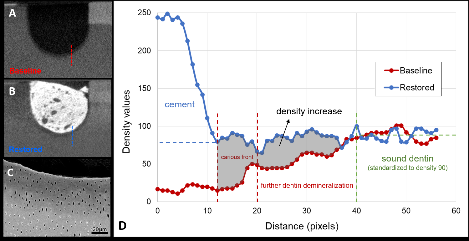 A) Baseline micro-CT slice showing carious dentin; B) The same carious cavity after restoration with zinc polycarboxylate cement; C) SEM image of the interface between control carious cavity and zinc polycarboxylate cement; D) Density profiles from lines depicted in A and B showing increase in density values in carious areas after zinc carboxylate restoration.