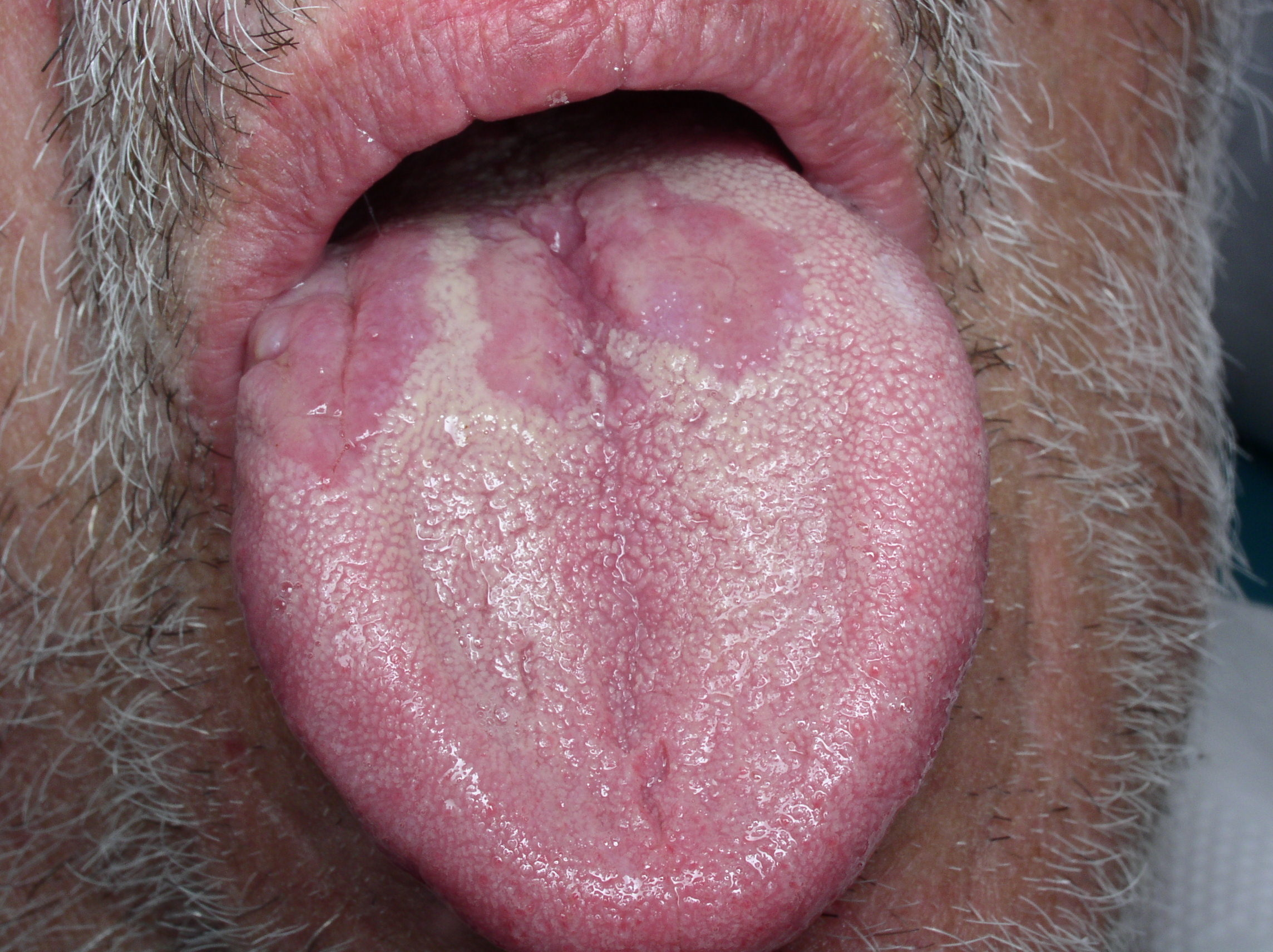 gonorrhea on tongue