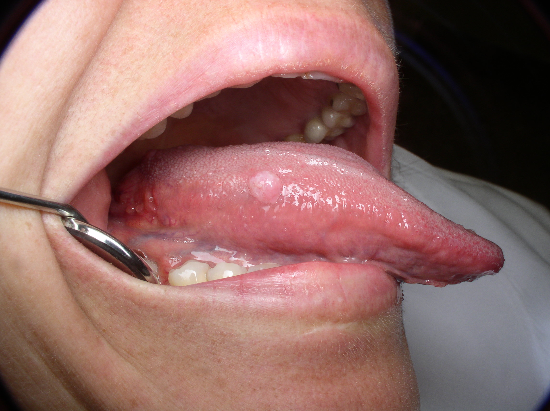 Papillomavirus on the tongue