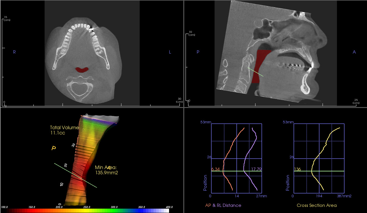 Narrowest cross-sectional area , AP and L dimensions of the airway and, airway volume measured from posterior nasal spine level to the most anterior and inferior level of second cervical vertebra by Invivo5 software