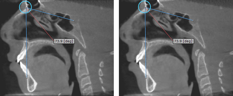 SNA and SNB angles measured by OnDemand3DApp software