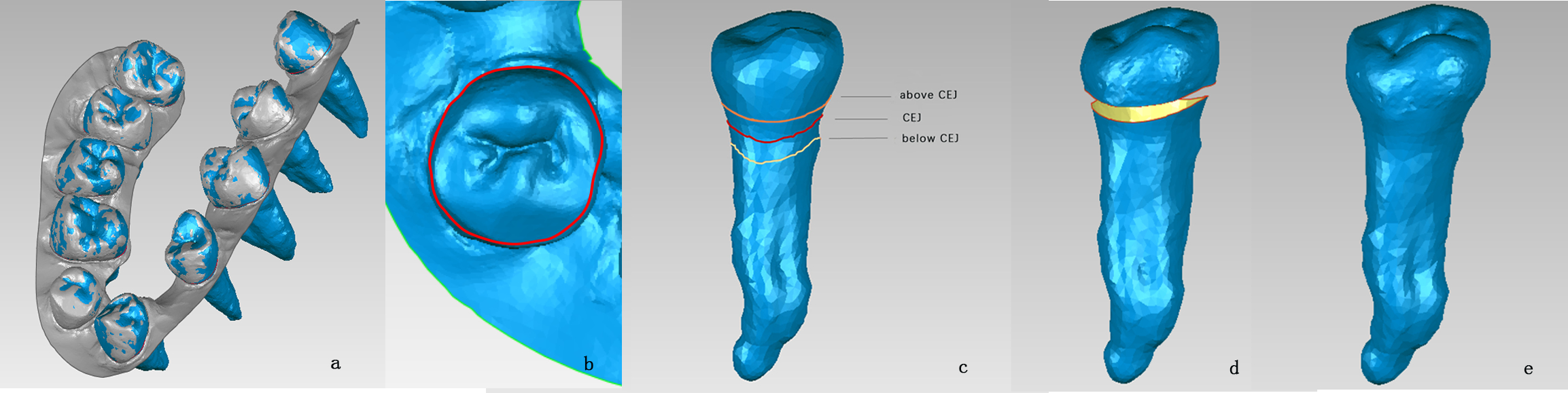 Fig.2<br />
a.registration 3D intraoral dentition model onto 3D CBCT dental model<br />
b.acquisition of crown-gingiva boundary<br />
c.offsetting and projecting crown-gingiva boundary<br />
d.filling function between 3D CBCT root and 3D intraoral crown<br />
e.3D fusion model