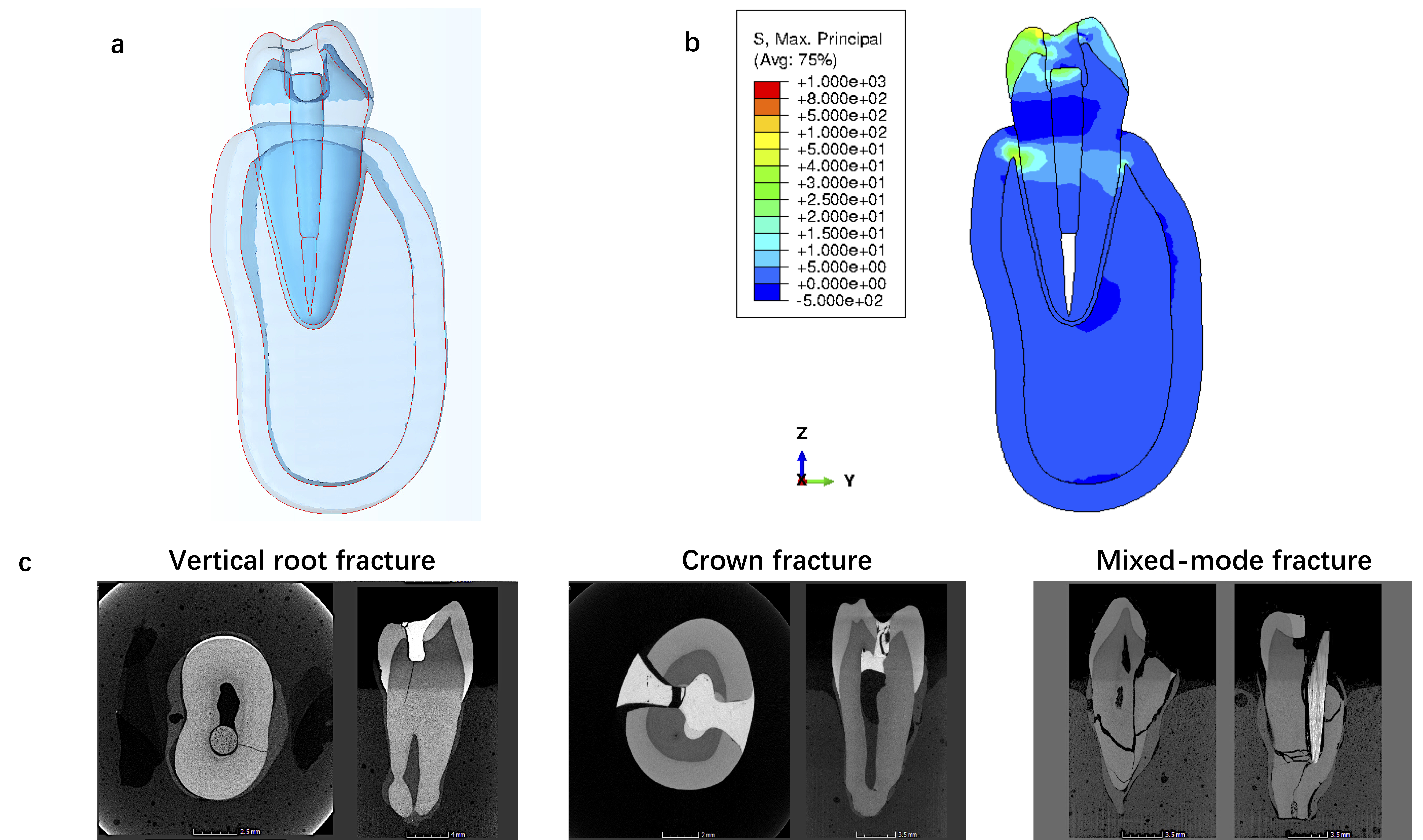 Figure 1<br />
a. 3D finite element model<br />
b. Maximum principal stress distributions<br />
c. Micro-CT images showing different fracture modes