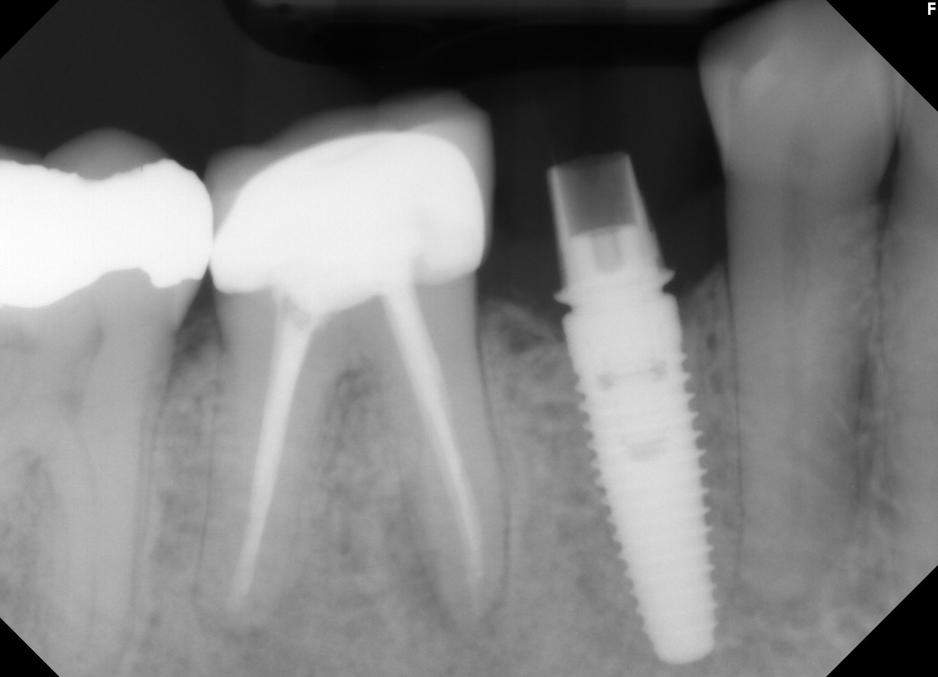 Periapical radiograph of tooth #29. Note that the Tibase and crown are fully seated