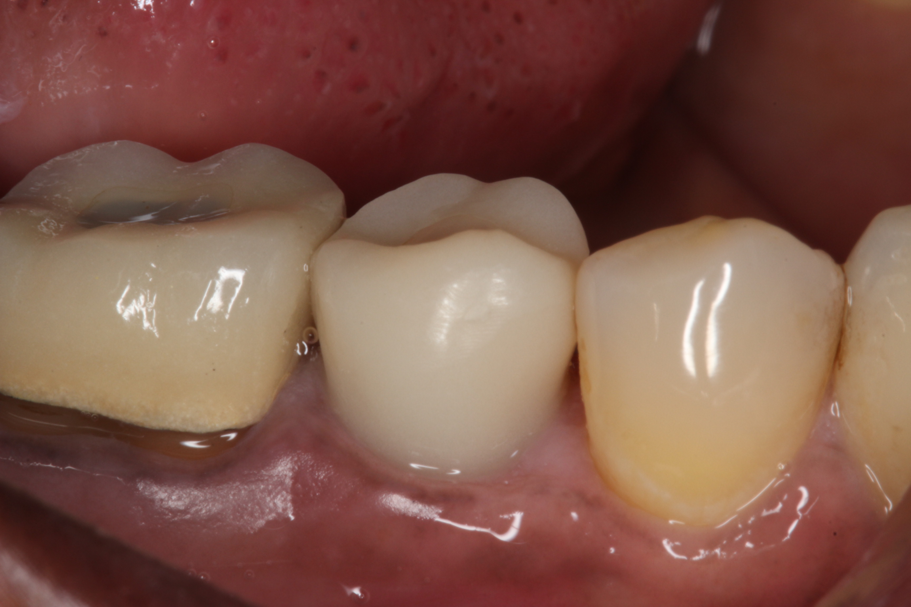 Clinical image of screw-retained implant resin provisional restoration on tooth #29 which is appropriately contoured to the gingival tissue
