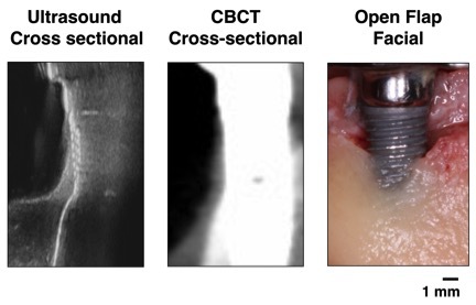 Representative ultrasound and CBCT cross-sectional images at the mid-facial site of an implant, as compared to an open-bone image.  The spatial relationships of peri-implant bone were comparable among the 3 images.  The ultrasound image, the implant surface, bone surface and soft tissues are clearly delineated.