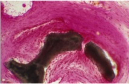 Figure 01  <i>Complete fibrous encapsulation of HA particles, 22 months after the operation.</i>