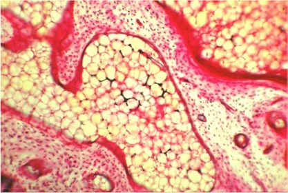 Fig 02 <i> Single HA particles in reticulum cells of the bone marrow indicate the path of resorption. </i><br />