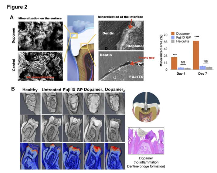 (A) The quantification of mineralized area on the surface of restorative dental materials. Schematic illustration and SEM images of mineral sealing between human dentin and restorative dental materials. (B) DOPAMER promoted dentin-bridge formation in vivo as evidenced by mCT scanning and H&E staining.
