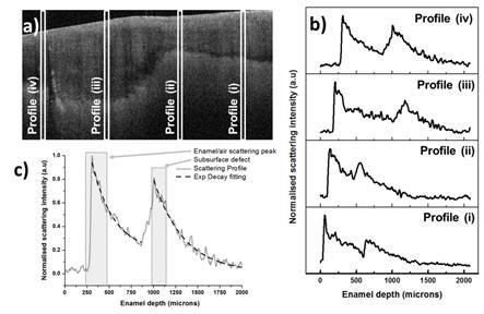 OCT B-scan and scattering profiles of an MIH lesion