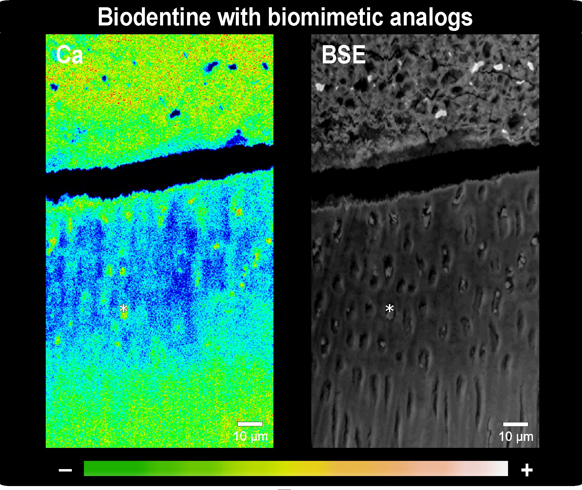 Chemical EPMA mapping of the interface of Biodentine (Septodont) with biomimetic analogs in contact with partially demineralized dentin upon 1-week simulated body fluid storage for Ca and the corresponding BSE photomicrograph are shown. Clear cement-dentin interface de-bonding, which might be attributed to the high vacuum environment in cross section polisher or EPMA, resulted in an approximately 15-µm wide gap, can be observed. Partially demineralized dentin indicated as the low calcium zone was approximately 80-µm thick.<br />
Deposited particles(marked with asterisk) in high concentration of calcium occluded the demineralized dentinal tubules. Similar phenomenon was observed in Biodentine (Septodont) alone or TCS50 with/without biomimetic analogs as well (not shown).