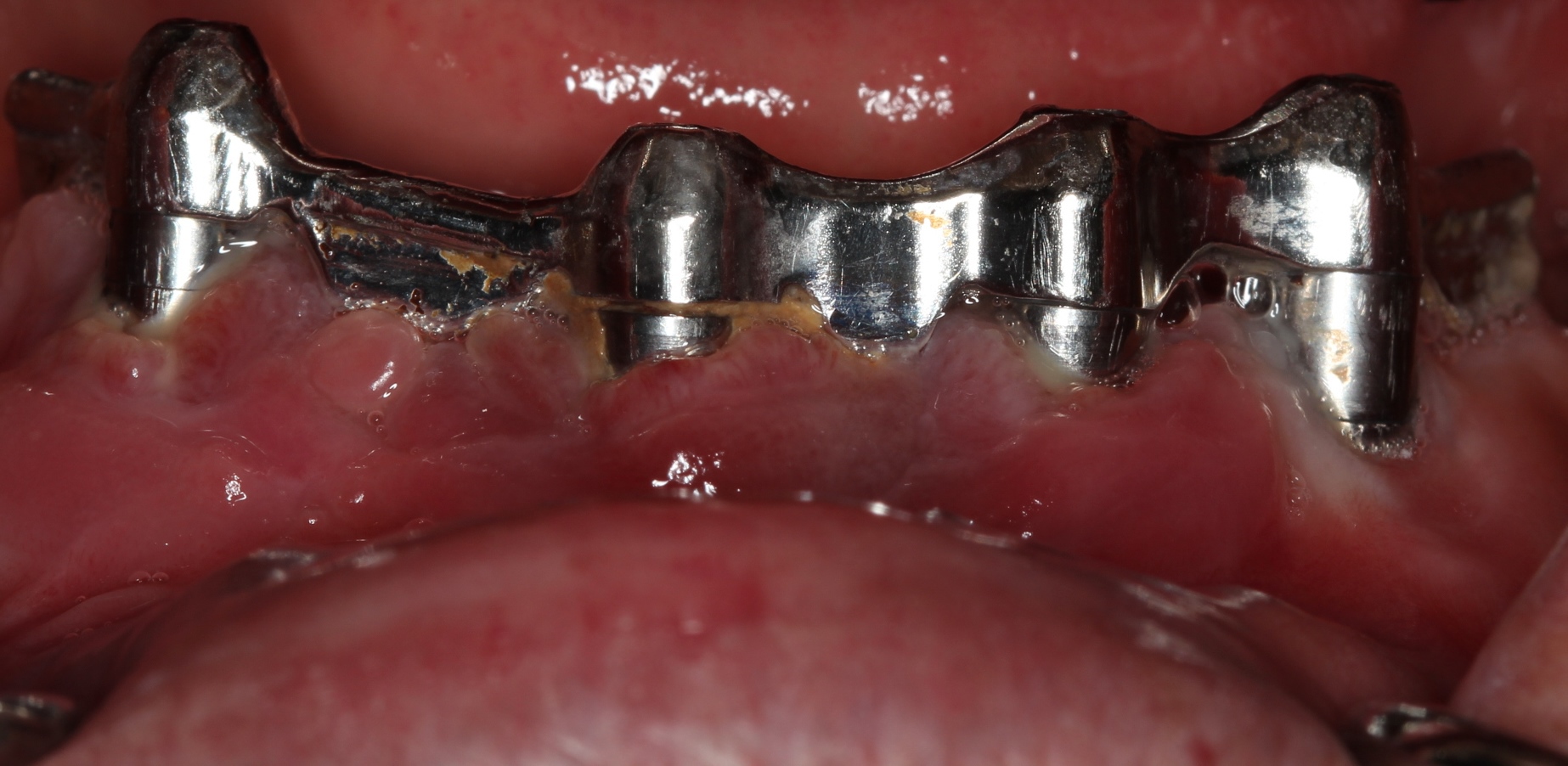 Peri-implantitis lesions surrounding implants