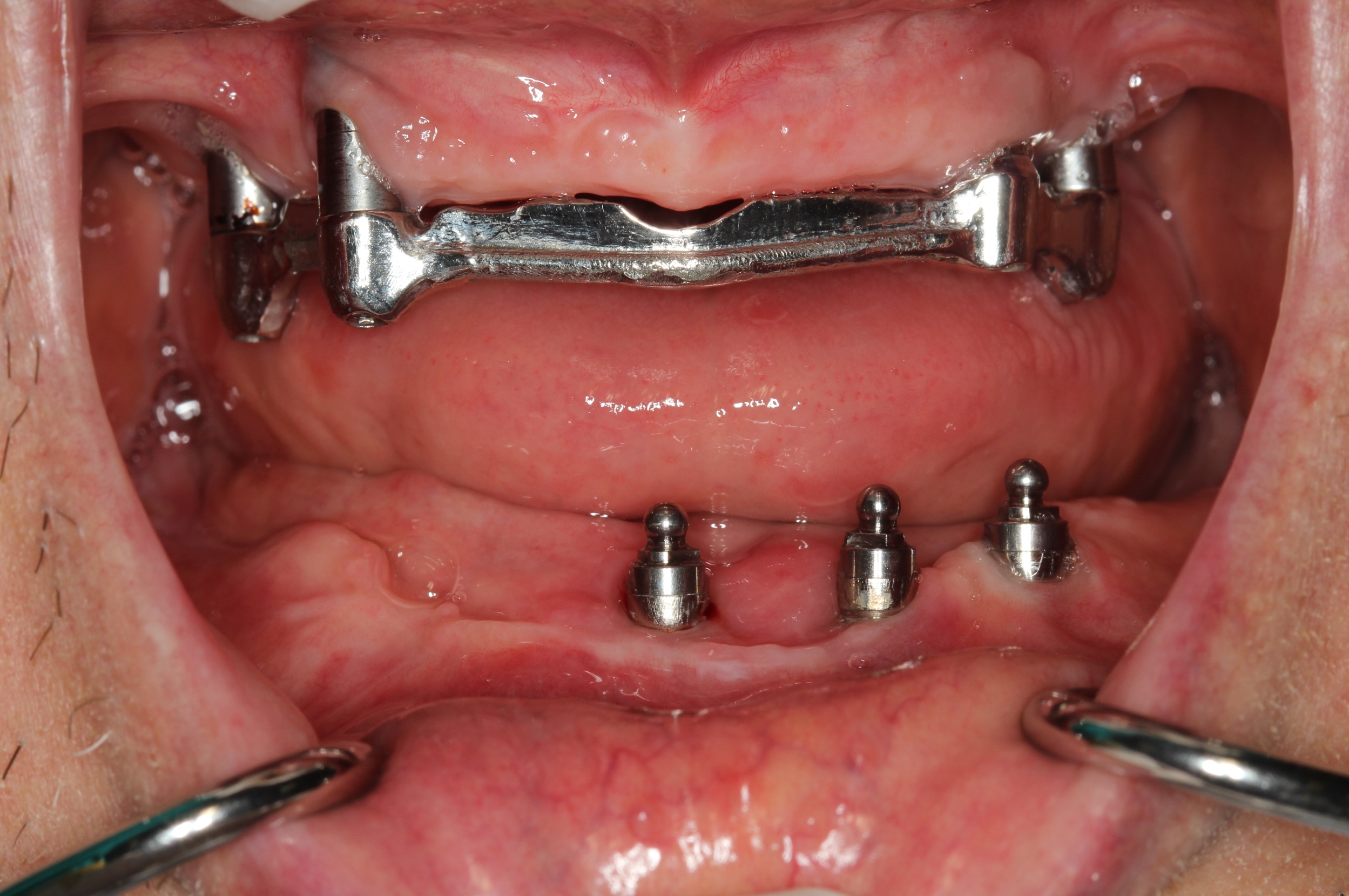 6 months after non-surgical treatment of peri-implantitis