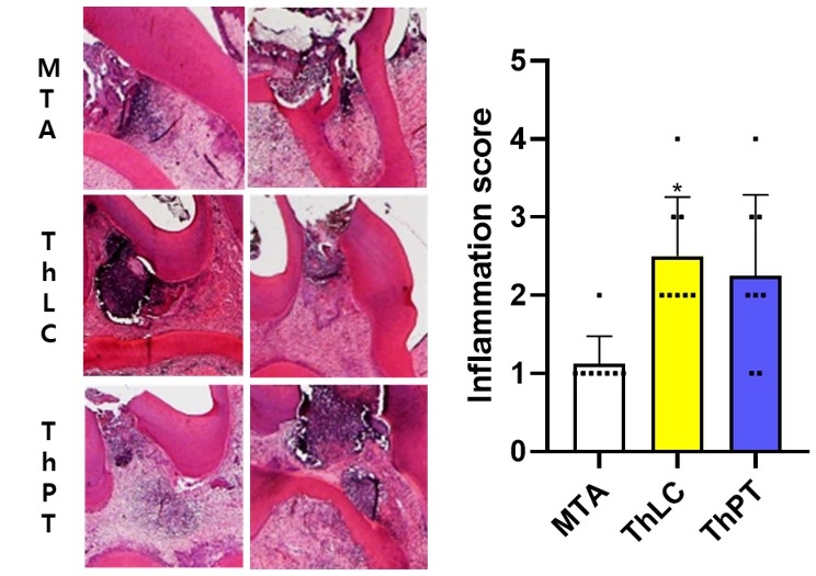 Figure 3. Histologic evaluation. TheraCal LC group showed significantly higher grade of pulp inflammation compared to MTA (<sup>*</sup><i>p</i> < 0.017). Degree of inflammation was assessed by the inflammation score (1 = no inflammation; 2 = less than 25% of inflammatory cells in ROI; 3 = less than 50% of inflammatory cells; 4 = more than 50% of inflammatory cells). MTA, ProRoot MTA; ThLC, TheraCal LC; ThPT, TheraCal PT.<br />
<br />
<quillbot-extension-portal></quillbot-extension-portal>