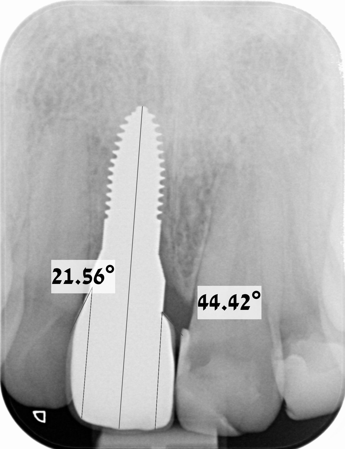 Intraoral periapical radiograph of a zirconium implant replacing a right maxillary central incisor. The total angle describing the emergence profile is 65.98°.