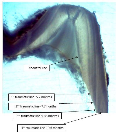 The location of the neonatal line in the second primary molar and the relative timing of the traumatic lines